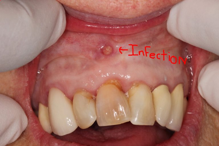 why-does-my-tooth-still-hurt-i-had-a-root-canal-isn-t-the-tooth-dead